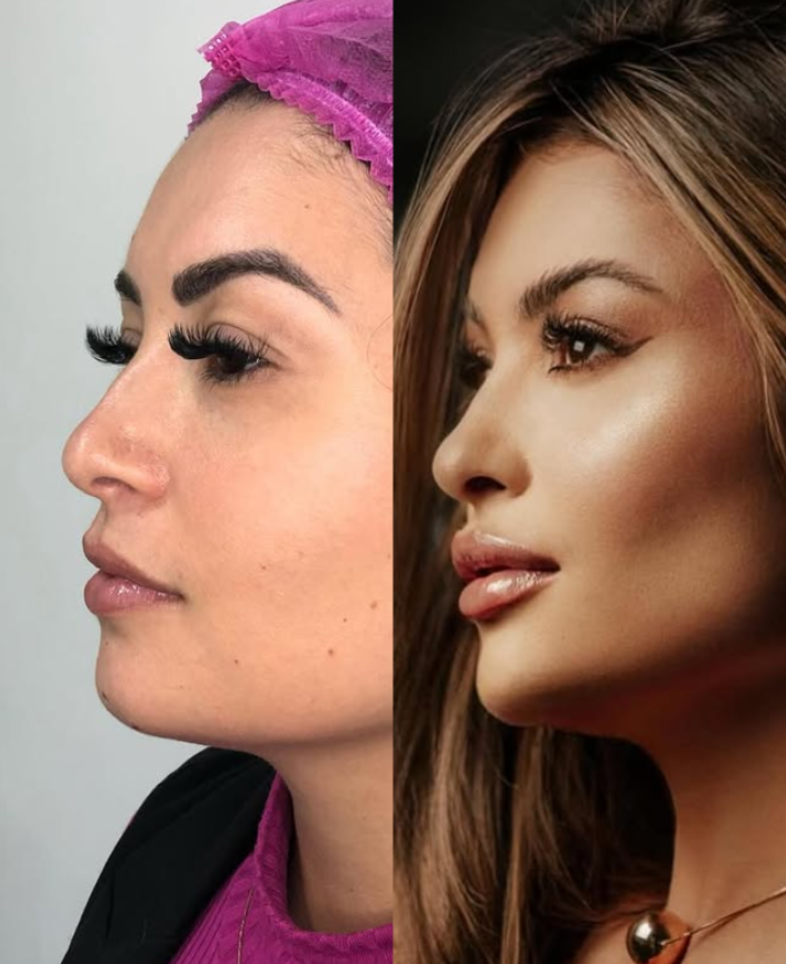 Antes e depois de perfiloplastia — refinamento do perfil facial na clínica Dra. Nicole Bonacolsi