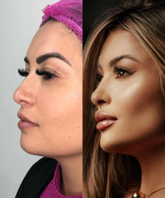 Antes e depois de harmonização facial — resultado natural com a Dra. Nicole Bonacolsi